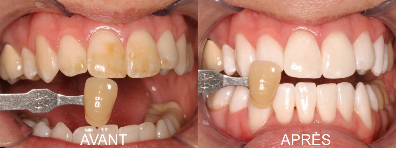 blanchiment des dents dentiste avant apres blanchiment des dents dentiste avant apres